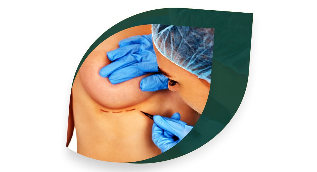 Breast surgery